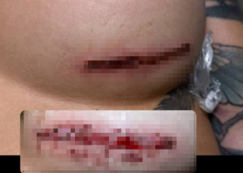 Участница телепроекта «Дом-2» Хромина пострадала от действий рязанских косметологов