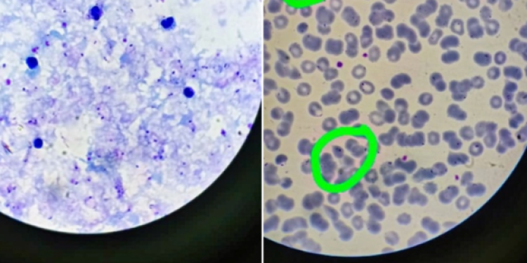 Врачи рязанской ОКБ имени Семашко помогли 37-летнему пациенту с малярией
