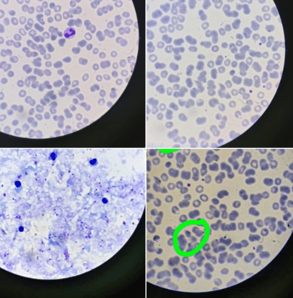 Врачи рязанской ОКБ имени Семашко помогли 37-летнему пациенту с малярией