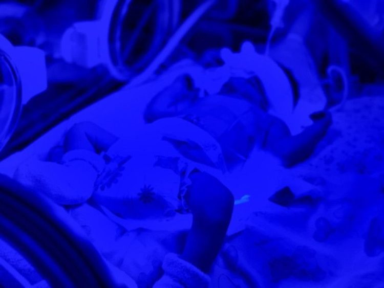 В Рязанском перинатальном центре на свет появился малышка с конфликтом по резус-фактору