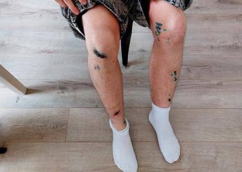 В районе рязанского ЦПКиО собаки покусали двух мужчин