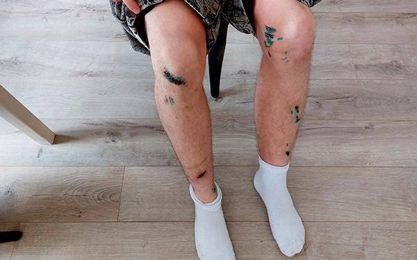 В районе рязанского ЦПКиО собаки покусали двух мужчин