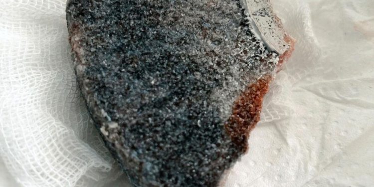 Врачи спасли россиянина с диском в голове Врачи спасли россиянина с диском в голове