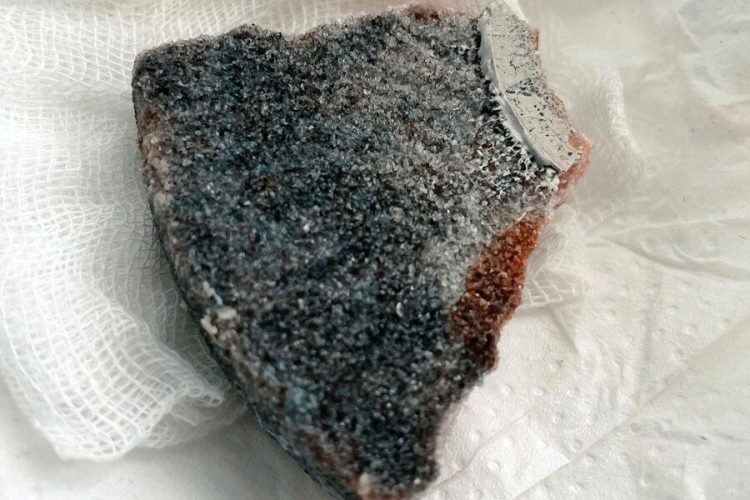 Врачи спасли россиянина с диском в голове