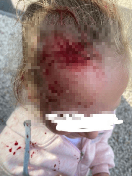 В рязанской Новопавловской роще качели рассекли голову маленькой девочке