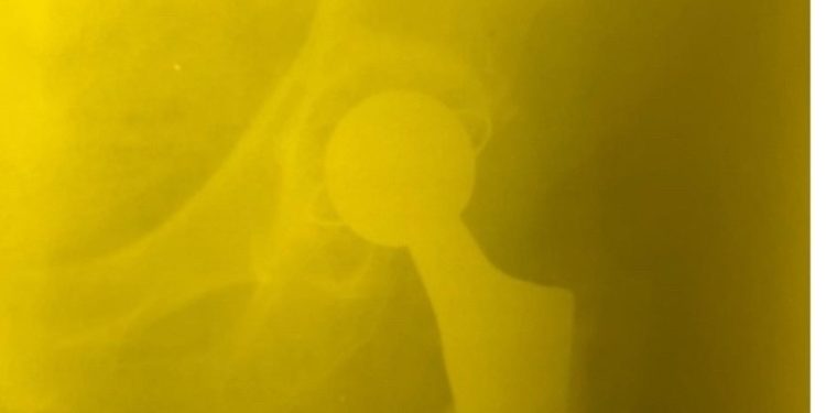 Рязанские врачи восстановили женщине ногу, которая после неудачной операции укоротилась на 5 сантиметров